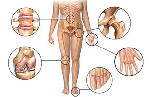 artritas rankose inflamația articulației degetelor