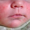 kudikiu alergija