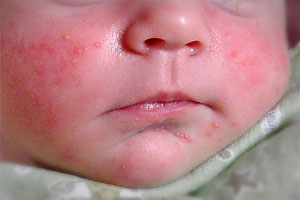 kudikiu alergija